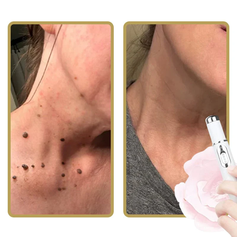 Avelena | ClearDerm - Schnelle, schmerzfreie Pickelentfernung für glatte, klare Haut - Image 3