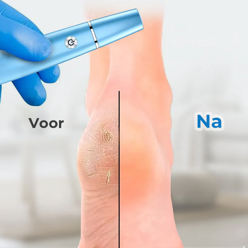 Avelena | SmoothFoot – Erreichen Sie in nur wenigen Minuten seidig glatte Füße - Image 5