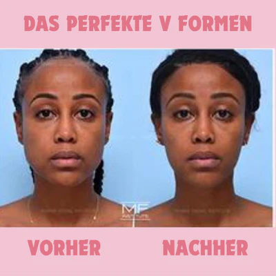 GesichtForm™ Definierende Kieferlinie Optimierung - Image 3